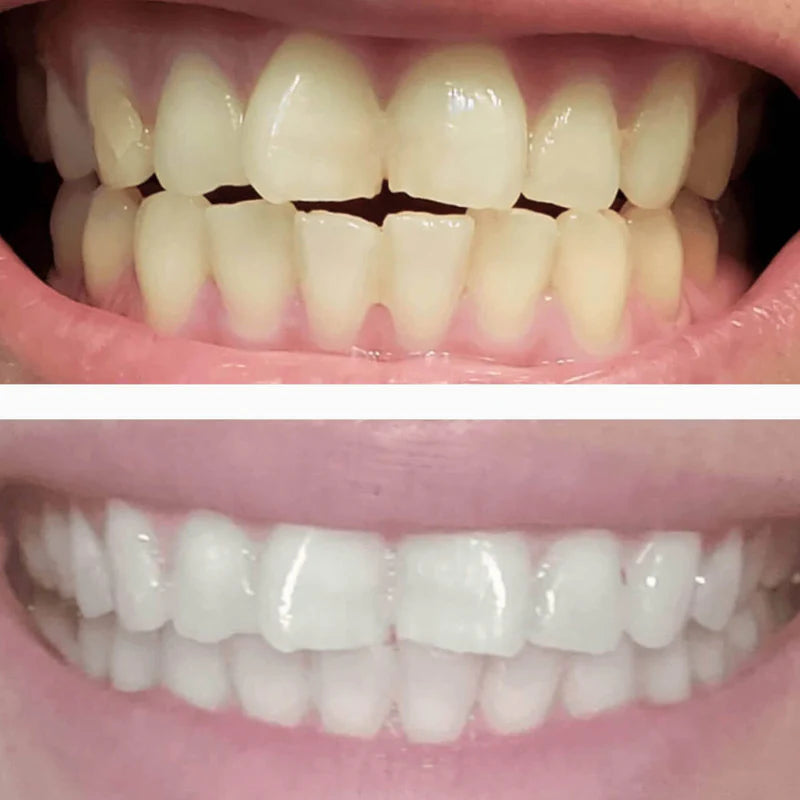 DiamondSeries® Wireless Teeth Whitening Kit with Hydroxyapatite & Triple LED Technology